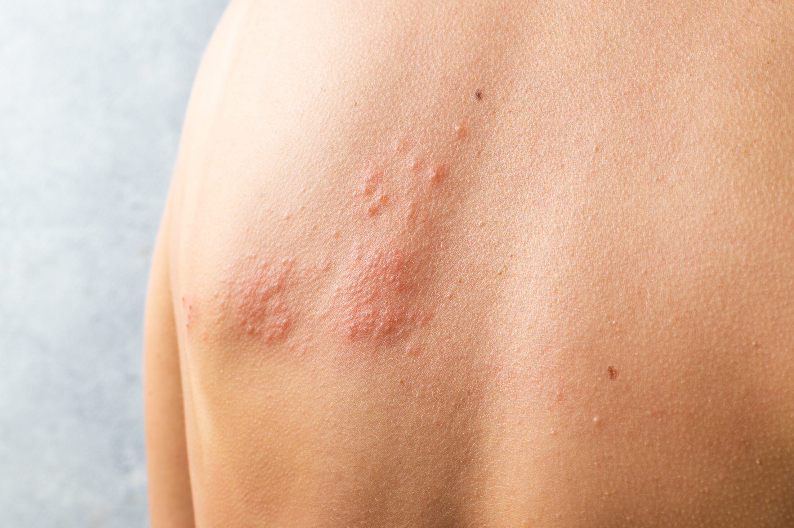 costas com herpes zoster